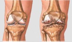 Хемартроза на колянната става: симптоми и лечение