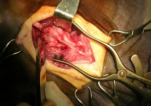 Ламиноктомия на гръбнака - операция за отстраняване на част от прешлена