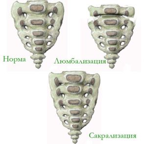 Ломбаризация s1 - аномалия на развитието на гръбначния стълб