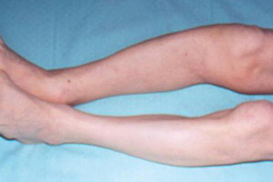 Остеодистрофия: патологично разрушаване на костната тъкан при хора