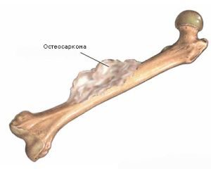 Остеолиза: когато костите се разтварят сами