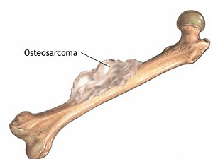 Остеосарком: злокачествен тумор, който засяга костите