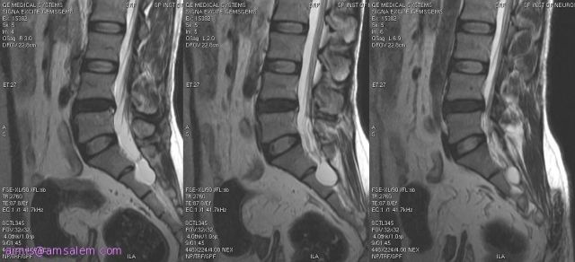 Перинеурална киста на гръбначния стълб: какво очаква пациентът?