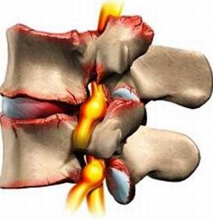 Полисегментарна остеохондроза на гръбначния стълб: подробности за основното