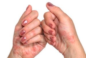 Псориатичен артрит - как да спрем двоен удар върху тялото?