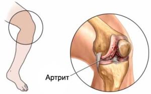 Пурпурен артрит - опасно ставно заболяване, трудно лечимо