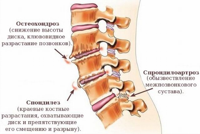 Признаци и лечение на спондилартроза на гръбначния стълб