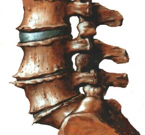 Признаци и лечение на спондилартроза на гръбначния стълб