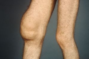 Признаци за развитие и лечение на хондроматоза на колянната става