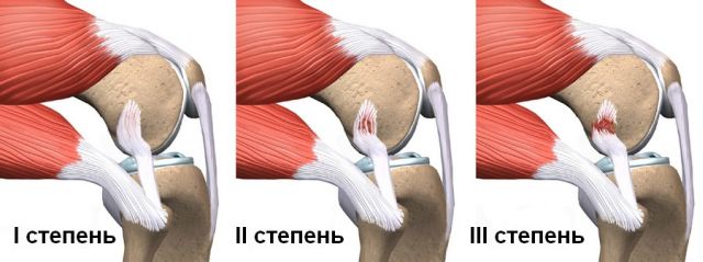 Навяхване на сухожилията на колянната става: първа помощ и лечение