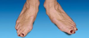 Симптоми и лечение на артроза на краката: съвети и техники