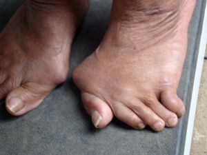 Симптоми и лечение на артроза на краката: съвети и техники