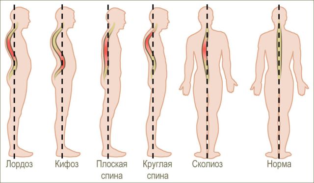 Симптоми и лечение на цефовична кърфоза на гръбначния стълб