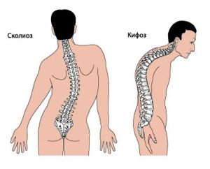 Симптоми и лечение на цефовична кърфоза на гръбначния стълб
