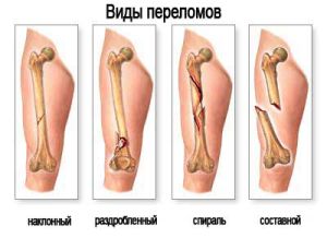 Симптоми и лечение на фрактури на краката в зависимост от местоположението и вида на травмата