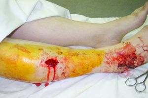 Симптоми и лечение на фрактури на краката в зависимост от местоположението и вида на травмата