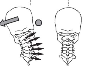 Симптоми и лечение на сколиоза на цервикалния гръбначен стълб