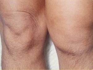 Симптоми, лечение и профилактика на остеопороза на колянната става