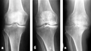 Симптоми, лечение и профилактика на остеопороза на колянната става