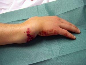 Симптоми, лечение и възстановяване след фрактура на ръката