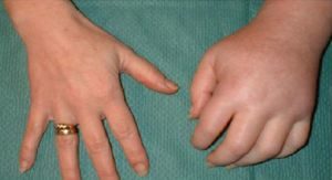 Синдром Зудека - синдром на болката, който настъпва след наранявания на крайниците