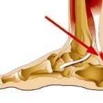 Тендонит Ахилесовото сухожилие: лечение, симптоми (снимка), причинява възпаление на крака