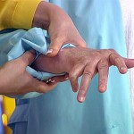 Първите симптоми на ревматоиден артрит на пръстите: снимка, лечение