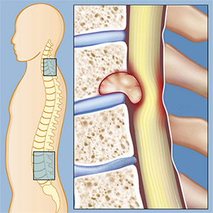 Първите симптоми, които показват рак на гръбначния стълб