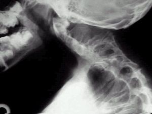 Синдромът на Klippel-Feil - рядка аномалия на гръбначния стълб
