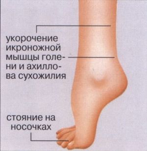 Лечение и възстановяване след пареза на крака