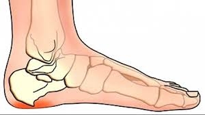Лечението на бурсит на крака изисква компетентен подход