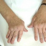 Лечение на остеоартроза на малки стави на ръцете и пръстите: как и какво да лекува DOA