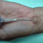 Лечение на хигрома на китката без хирургия (компреси, лазер)