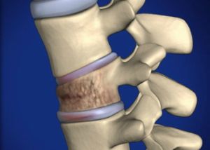 Vertebroplasty ще възстанови поддържащите функции на гръбначния стълб
