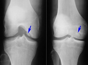 Какви са остеофитите и тръните на колянната става и как да ги премахнете?