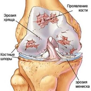 Какви са остеофитите и тръните на колянната става и как да ги премахнете?