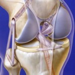 Какво представлява артродезата на ставата (коляно, глезена), коментари за операцията