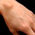 Какво представлява хигрома: причините за настъпване на ръката и крака, как да се лекува (премахване)