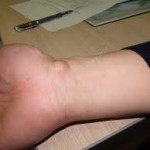 Какво представлява хигрома: причините за настъпване на ръката и крака, как да се лекува (премахване)