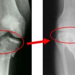 Какво представлява ганартроза на колянната става: причини, признаци, превенция
