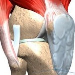Какво представлява лигаментозата: лечението на кръстосаните връзки на ставата (коляно, тазобедрената става, глезена)