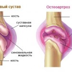 Какво представлява остеоартрит: описание (снимка), класификация (етапи), причини и диагноза на заболяването