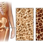 Какво представлява остеопорозата: причини, симптоми (признаци) и лечение на костни заболявания