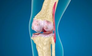 Какво представлява патолофеморалната артроза на колянната става?