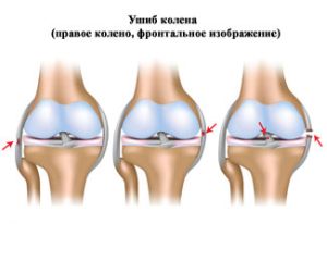 Какво да направите с нараняване на коляното: първа помощ и лечение