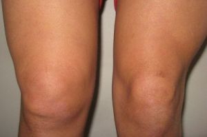 Какво да направите с нараняване на коляното: първа помощ и лечение