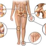 Остър артрит на ставите: симптоми и лечение