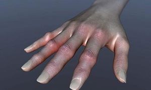Алергичен артрит: Причини и методи на лечение