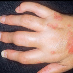 Алергичен артрит: симптоми и лечение при деца и възрастни