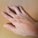 Артрит на ръцете: лечение, симптоми и снимки на ранен етап